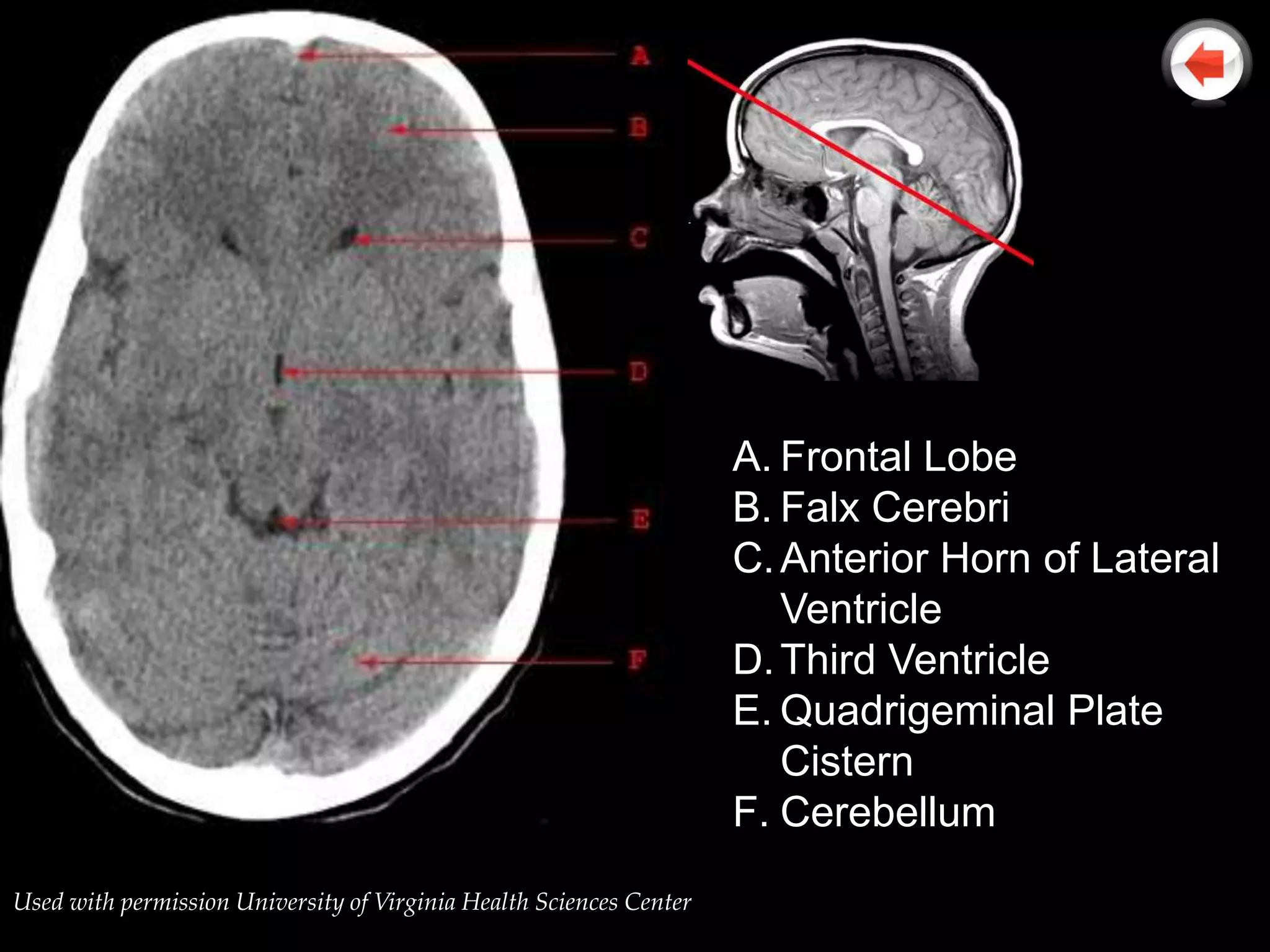 A. Frontal Lobe
                                                                     B. Falx Cerebri
                                                                     C. Anterior Horn of Lateral
                                                                        Ventricle
                                                                     D. Third Ventricle
                                                                     E. Quadrigeminal Plate
                                                                        Cistern
                                                                     F. Cerebellum
Used with permission University of Virginia Health Sciences Center
 