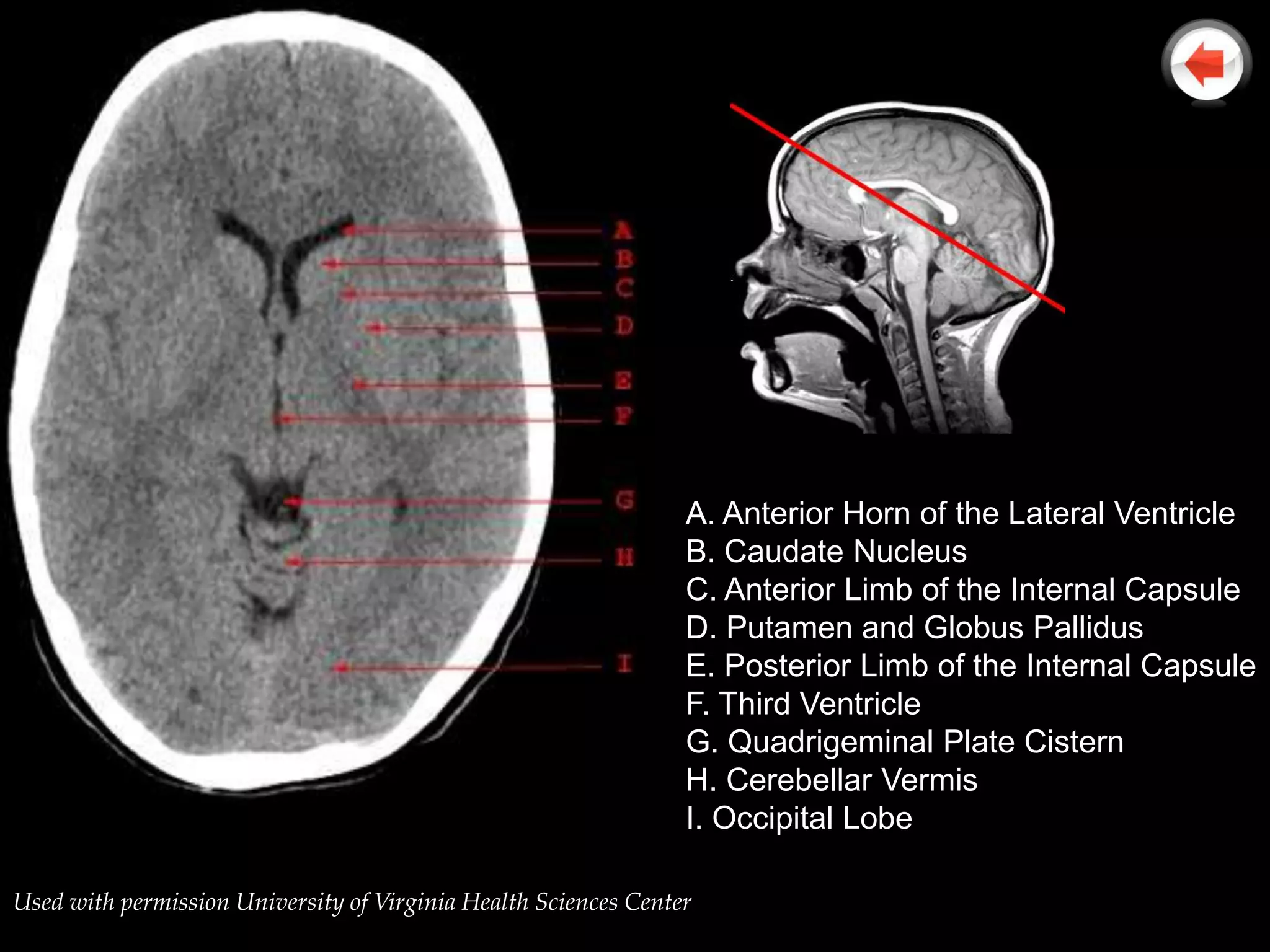 A. Anterior Horn of the Lateral Ventricle
                                                                 B. Caudate Nucleus
                                                                 C. Anterior Limb of the Internal Capsule
                                                                 D. Putamen and Globus Pallidus
                                                                 E. Posterior Limb of the Internal Capsule
                                                                 F. Third Ventricle
                                                                 G. Quadrigeminal Plate Cistern
                                                                 H. Cerebellar Vermis
                                                                 I. Occipital Lobe

Used with permission University of Virginia Health Sciences Center
 