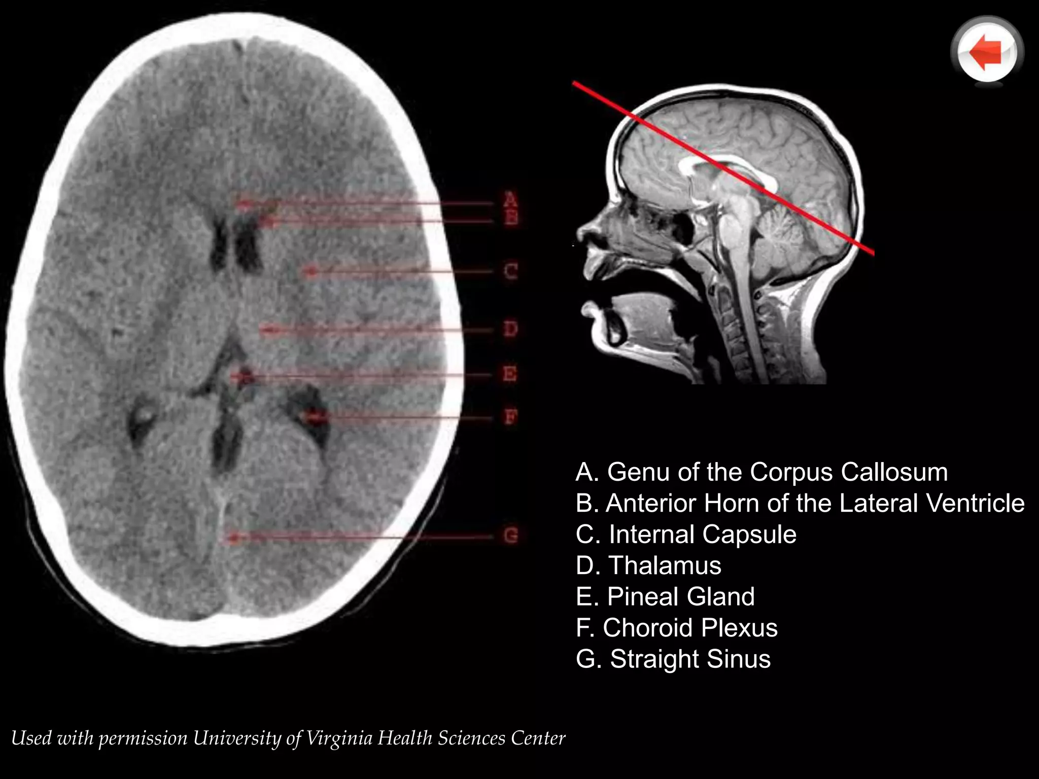 A. Genu of the Corpus Callosum
                                                                     B. Anterior Horn of the Lateral Ventricle
                                                                     C. Internal Capsule
                                                                     D. Thalamus
                                                                     E. Pineal Gland
                                                                     F. Choroid Plexus
                                                                     G. Straight Sinus

Used with permission University of Virginia Health Sciences Center
 