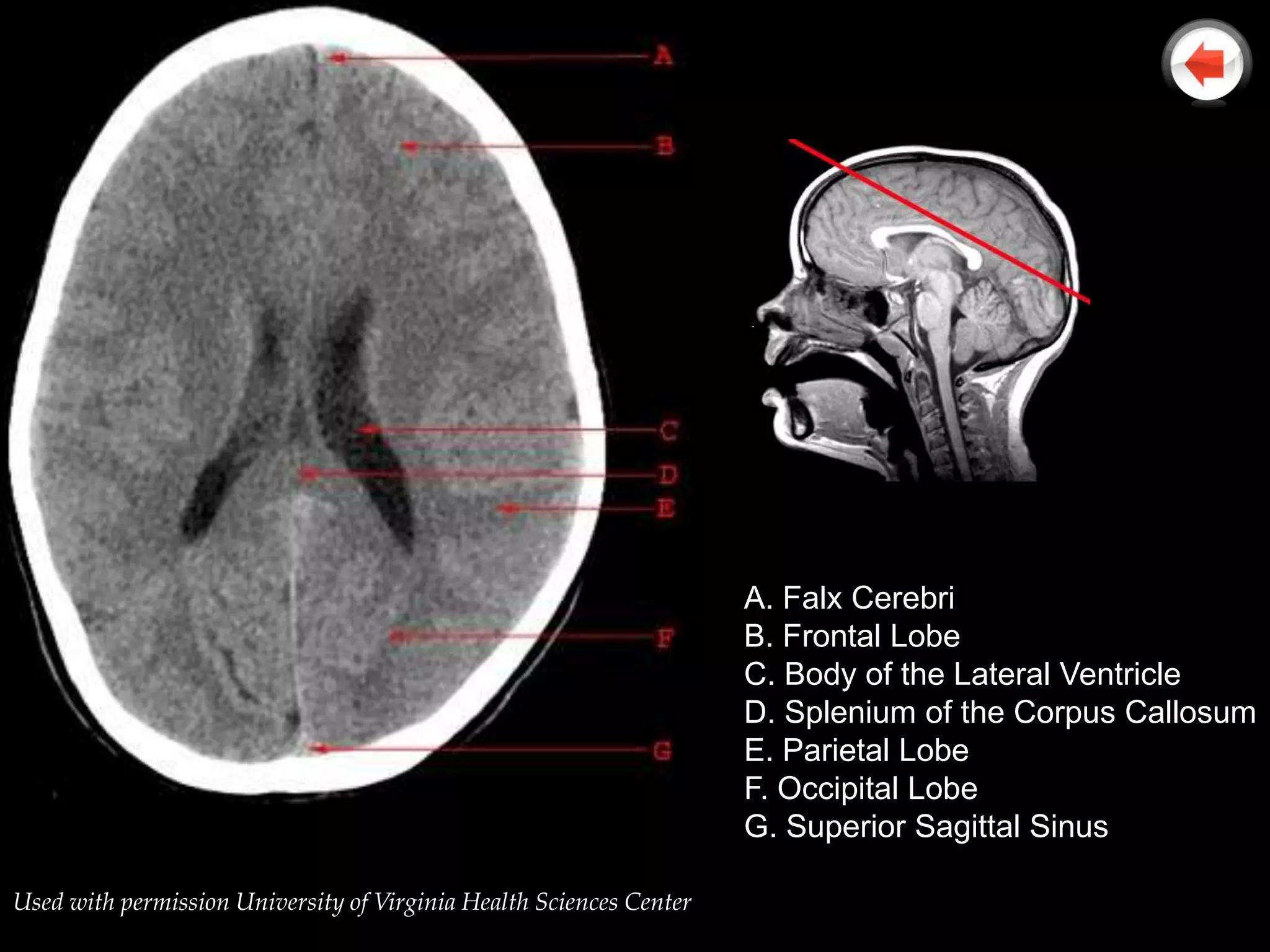 A. Falx Cerebri
                                                                     B. Frontal Lobe
                                                                     C. Body of the Lateral Ventricle
                                                                     D. Splenium of the Corpus Callosum
                                                                     E. Parietal Lobe
                                                                     F. Occipital Lobe
                                                                     G. Superior Sagittal Sinus

Used with permission University of Virginia Health Sciences Center
 