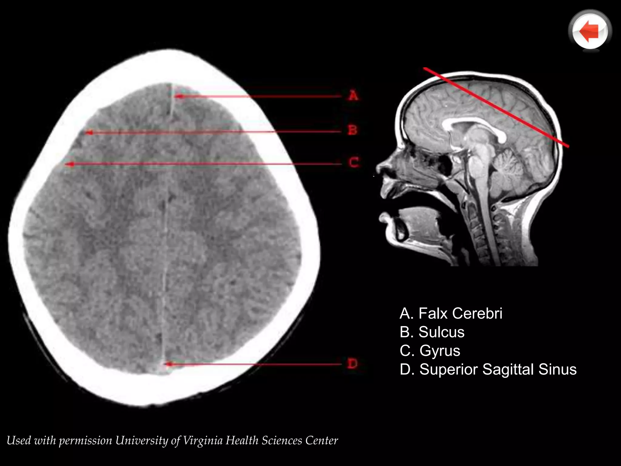 A. Falx Cerebri
                                                                     B. Sulcus
                                                                     C. Gyrus
                                                                     D. Superior Sagittal Sinus



Used with permission University of Virginia Health Sciences Center
 
