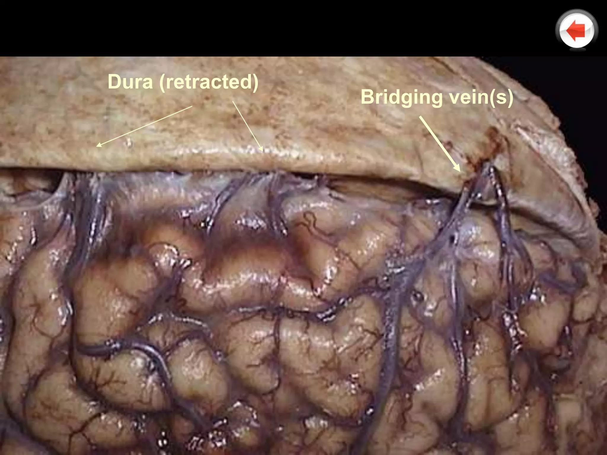 Dura (retracted)
                   Bridging vein(s)
 