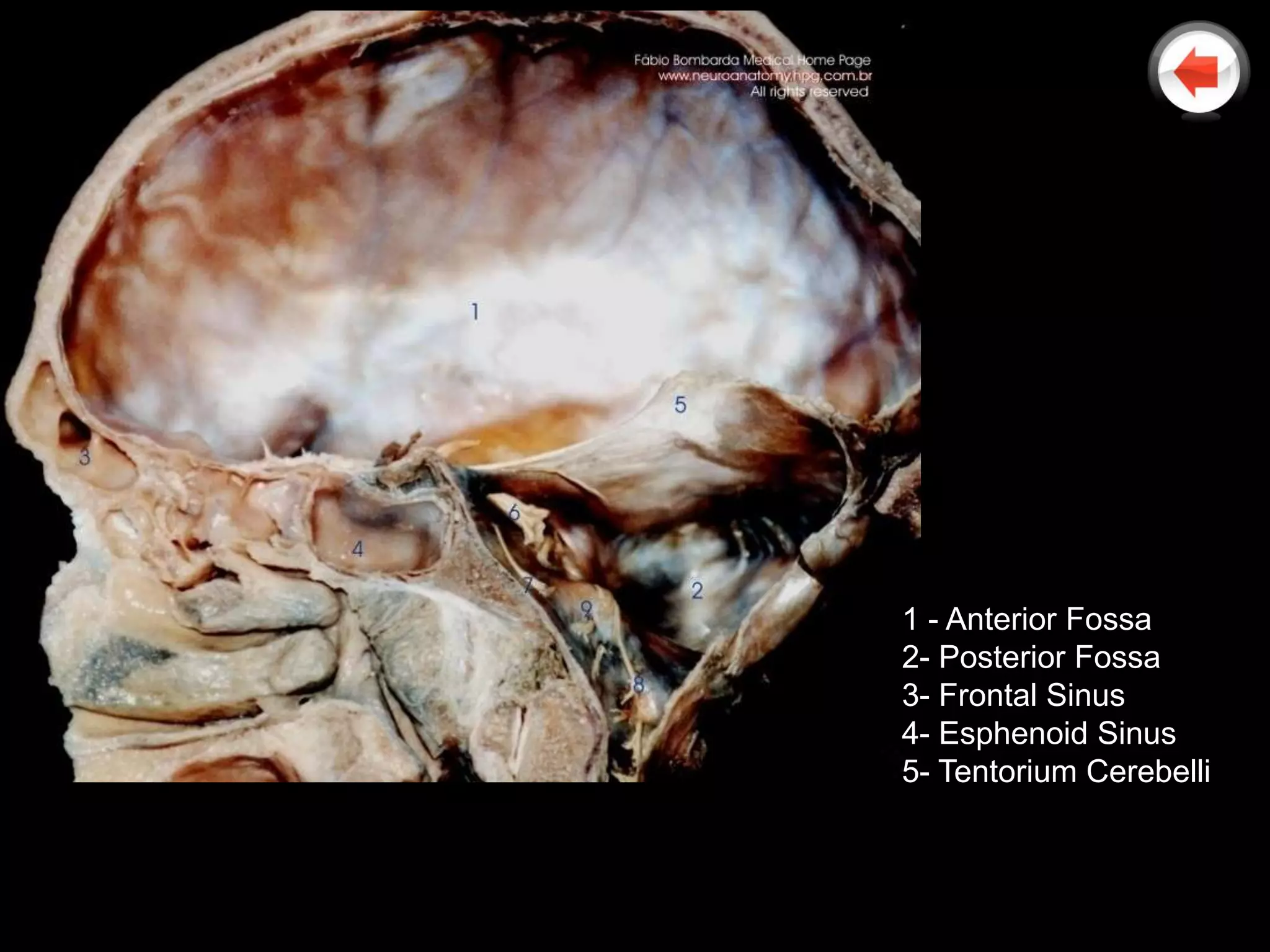 1 - Anterior Fossa
2- Posterior Fossa
3- Frontal Sinus
4- Esphenoid Sinus
5- Tentorium Cerebelli
 