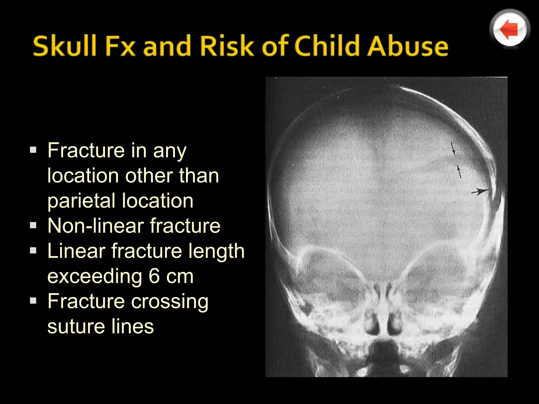  Fracture in any
  location other than
  parietal location
 Non-linear fracture
 Linear fracture length
  exceeding 6 cm
 Fracture crossing
  suture lines
 
