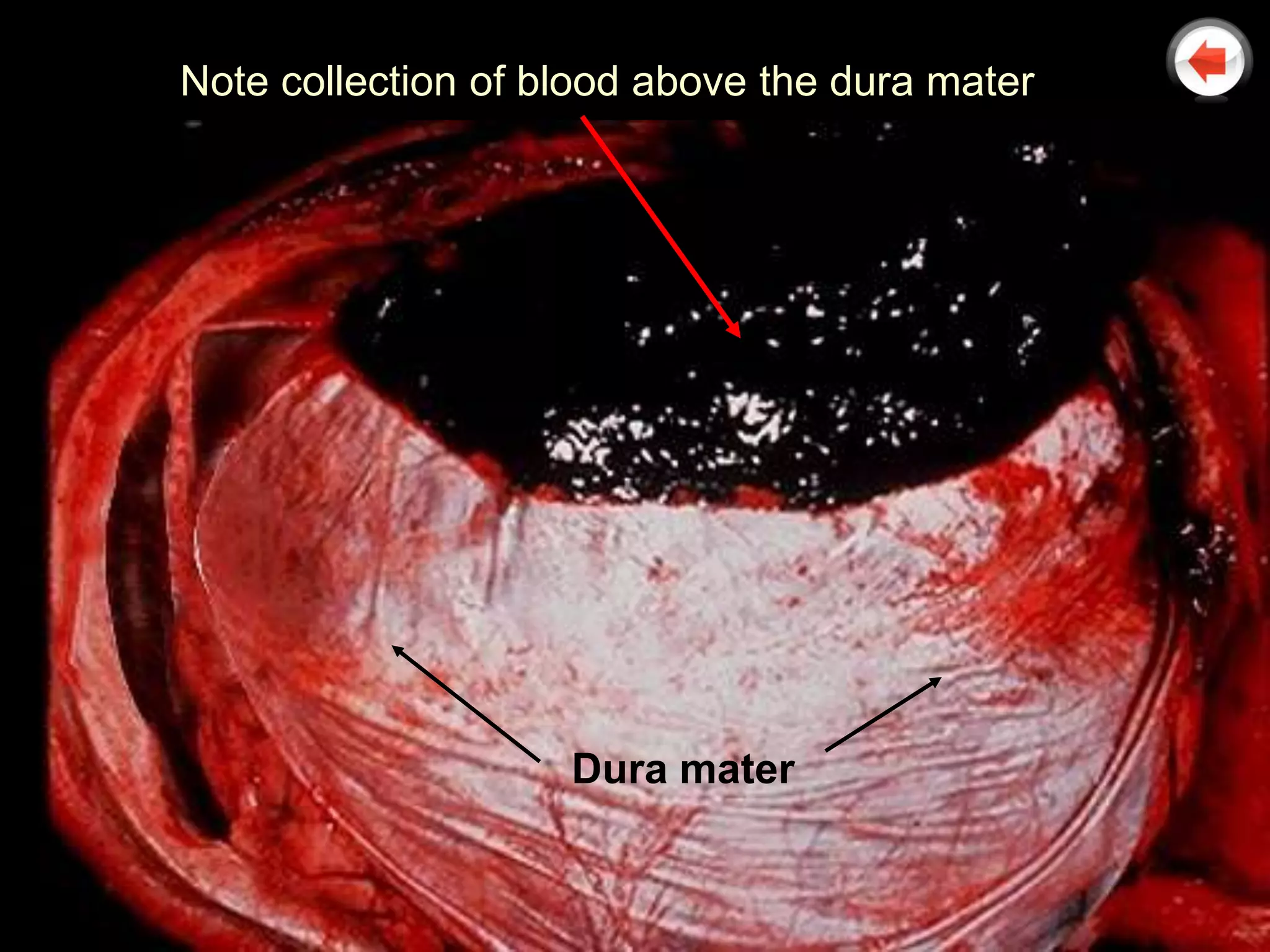 Note collection of blood above the dura mater




                    Dura mater
 