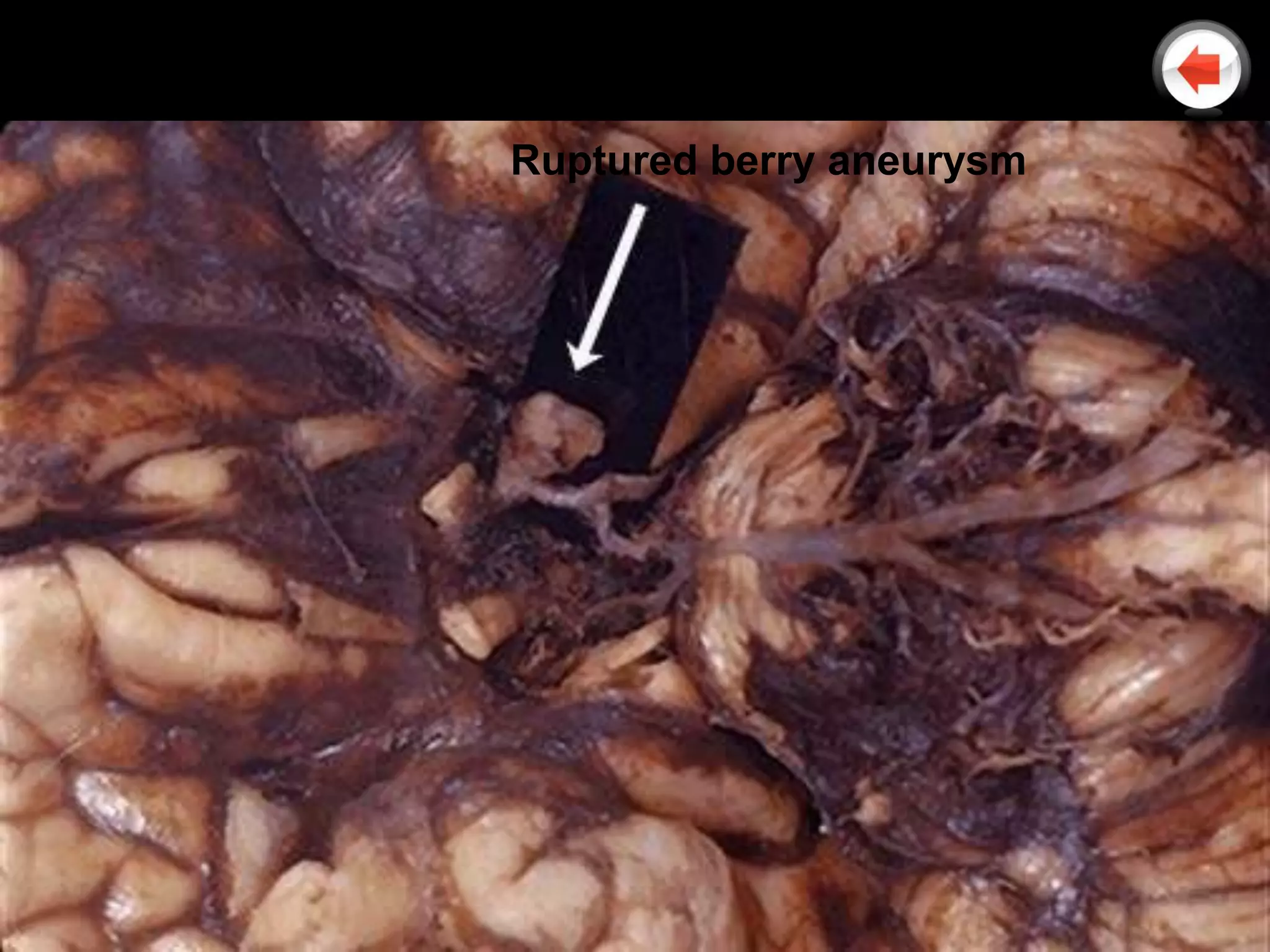 Ruptured berry aneurysm
 