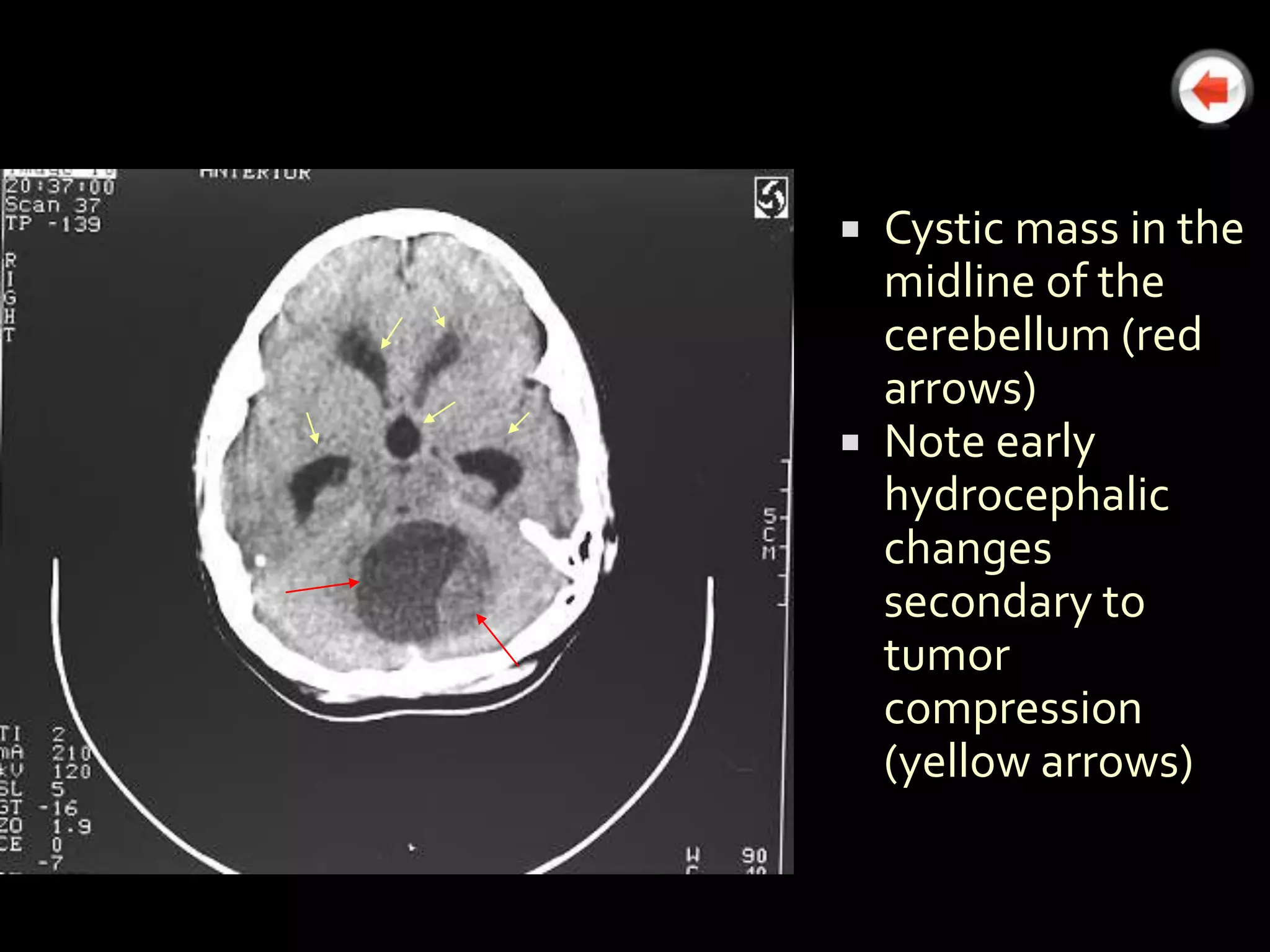  Cystic mass in the
  midline of the
  cerebellum (red
  arrows)
 Note early
  hydrocephalic
  changes
  secondary to
  tumor
  compression
  (yellow arrows)
 