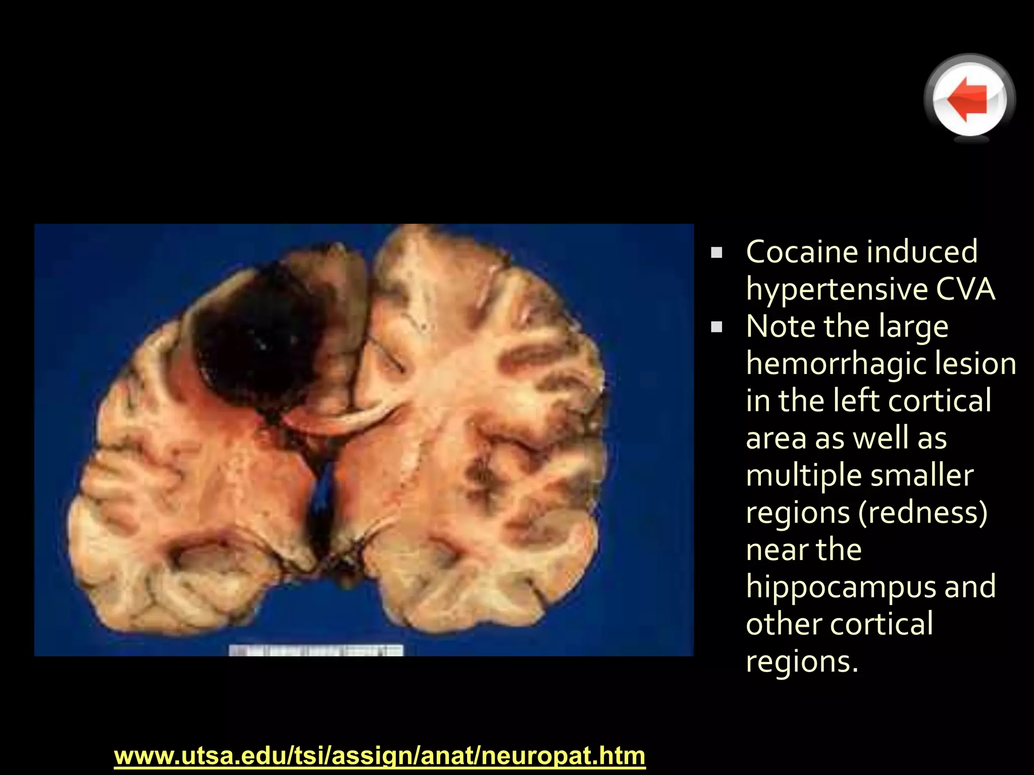    Cocaine induced
                                                hypertensive CVA
                                               Note the large
                                                hemorrhagic lesion
                                                in the left cortical
                                                area as well as
                                                multiple smaller
                                                regions (redness)
                                                near the
                                                hippocampus and
                                                other cortical
                                                regions.

www.utsa.edu/tsi/assign/anat/neuropat.htm
 