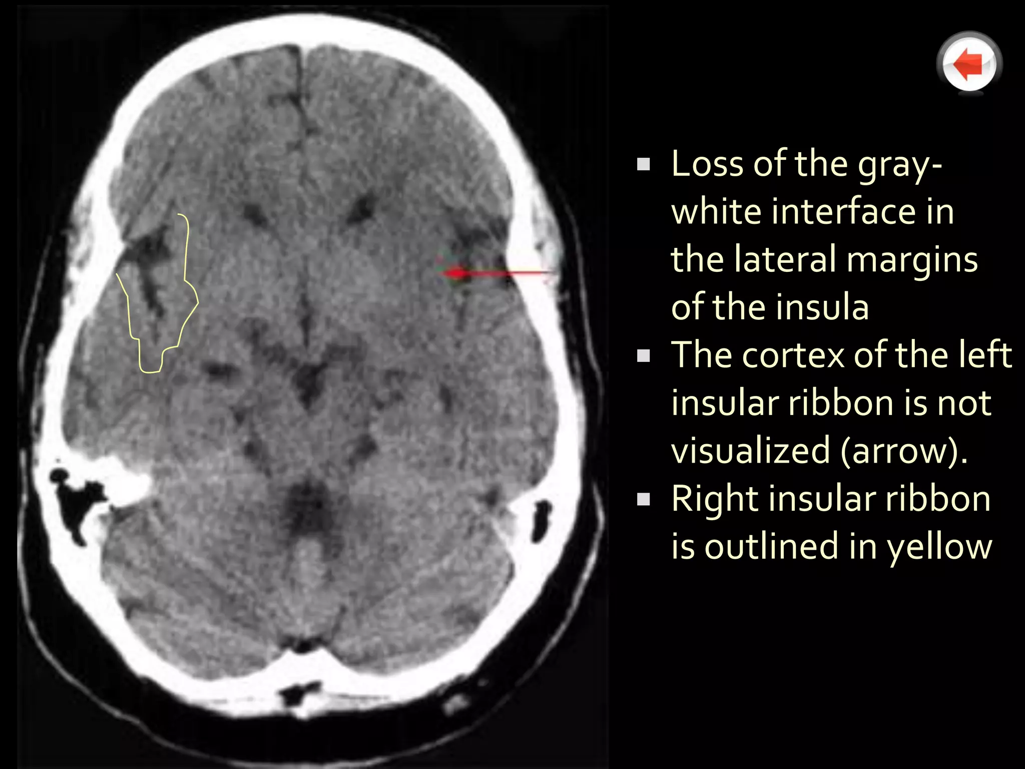  Loss of the gray-
  white interface in
  the lateral margins
  of the insula
 The cortex of the left
  insular ribbon is not
  visualized (arrow).
 Right insular ribbon
  is outlined in yellow
 