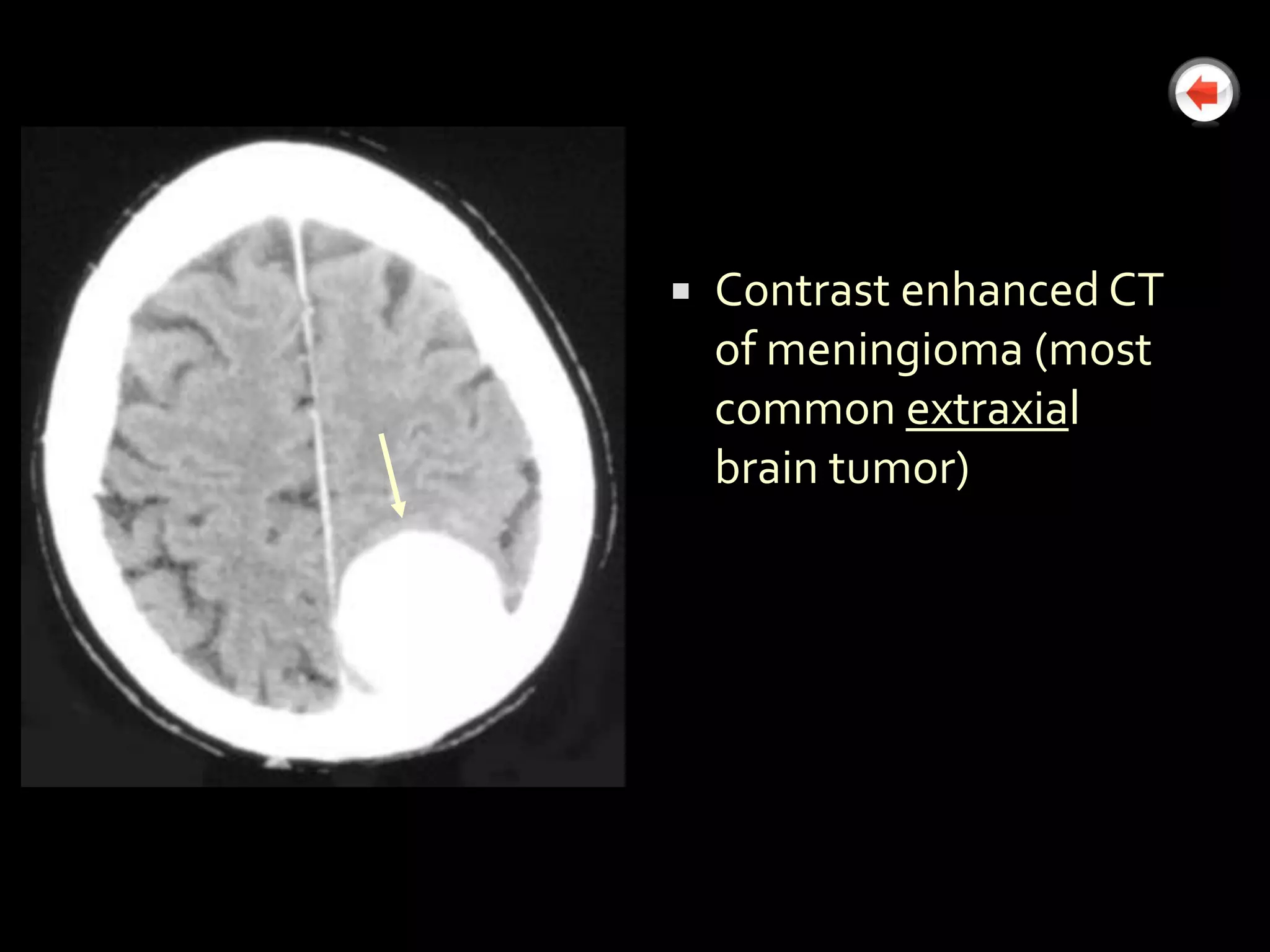    Contrast enhanced CT
    of meningioma (most
    common extraxial
    brain tumor)
 