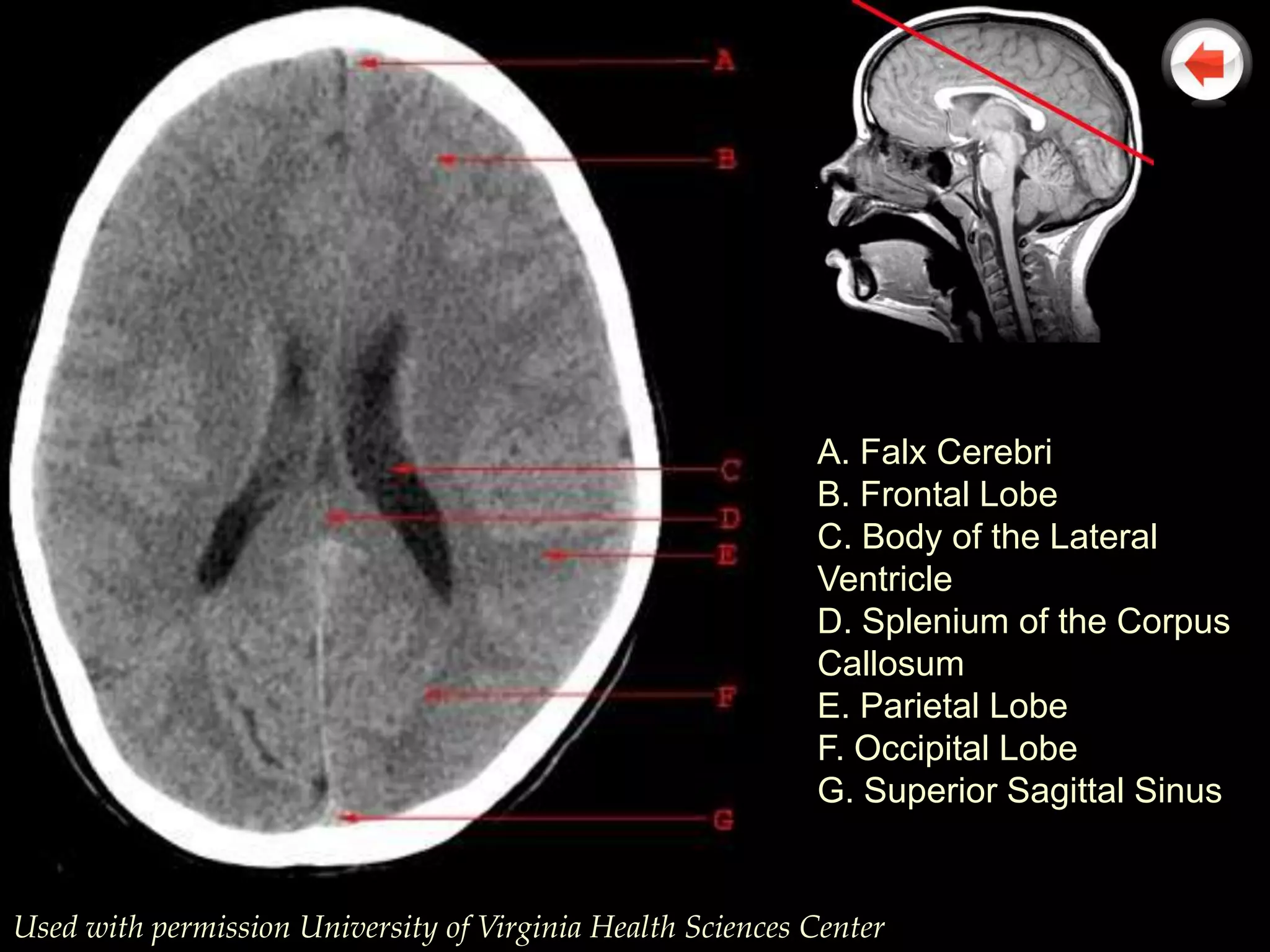 A. Falx Cerebri
                                                            B. Frontal Lobe
                                                            C. Body of the Lateral
                                                            Ventricle
                                                            D. Splenium of the Corpus
                                                            Callosum
                                                            E. Parietal Lobe
                                                            F. Occipital Lobe
                                                            G. Superior Sagittal Sinus


Used with permission University of Virginia Health Sciences Center
 