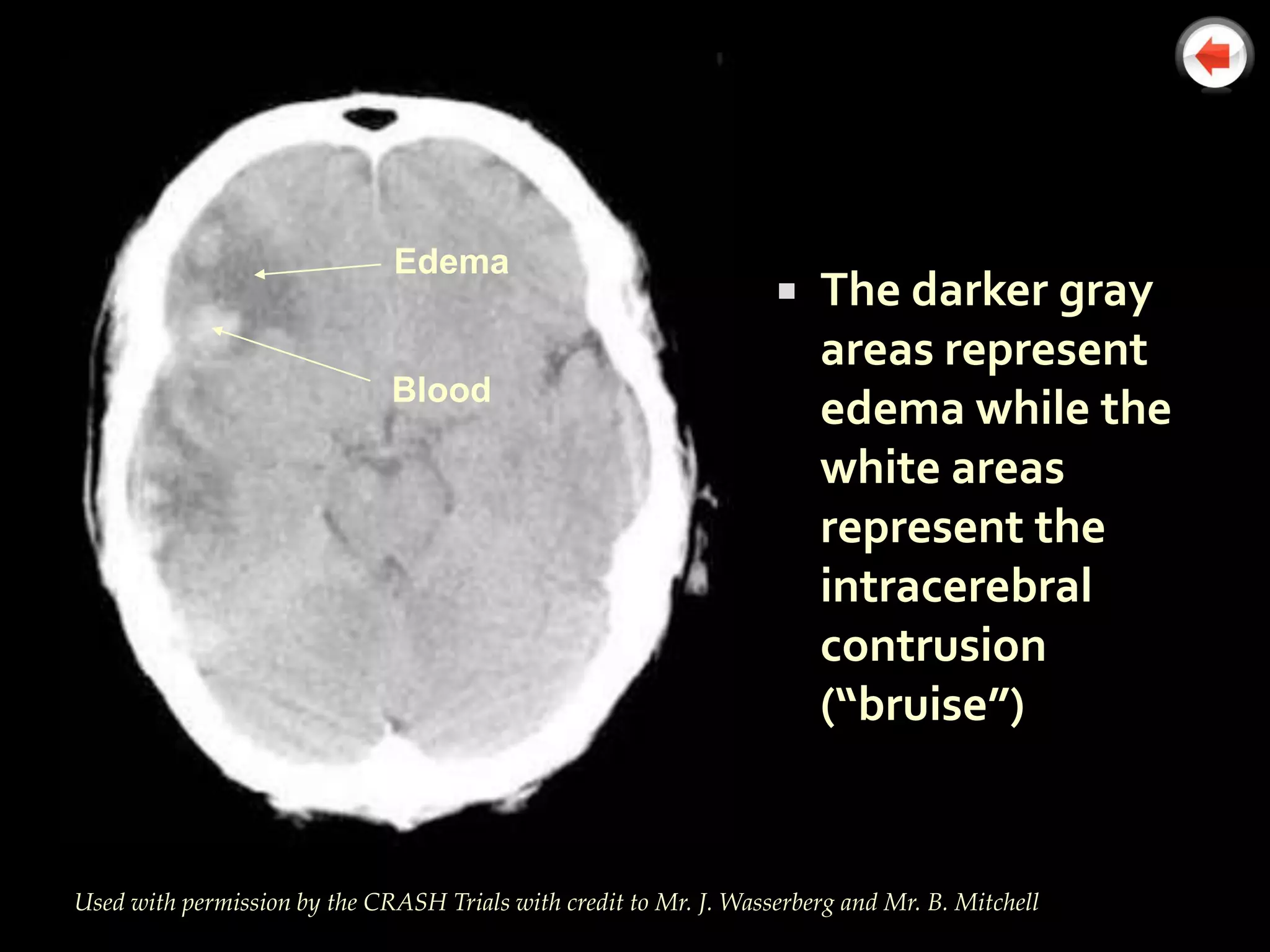 Edema
                                                                      The darker gray
                     Edema
                                                                       areas represent
                              Blood
                      Blood                                            edema while the
                                                                       white areas
                                                                       represent the
                                                                       intracerebral
                                                                       contrusion
                                                                       (“bruise”)


Used with permission by the CRASH Trials with credit to Mr. J. Wasserberg and Mr. B. Mitchell
 
