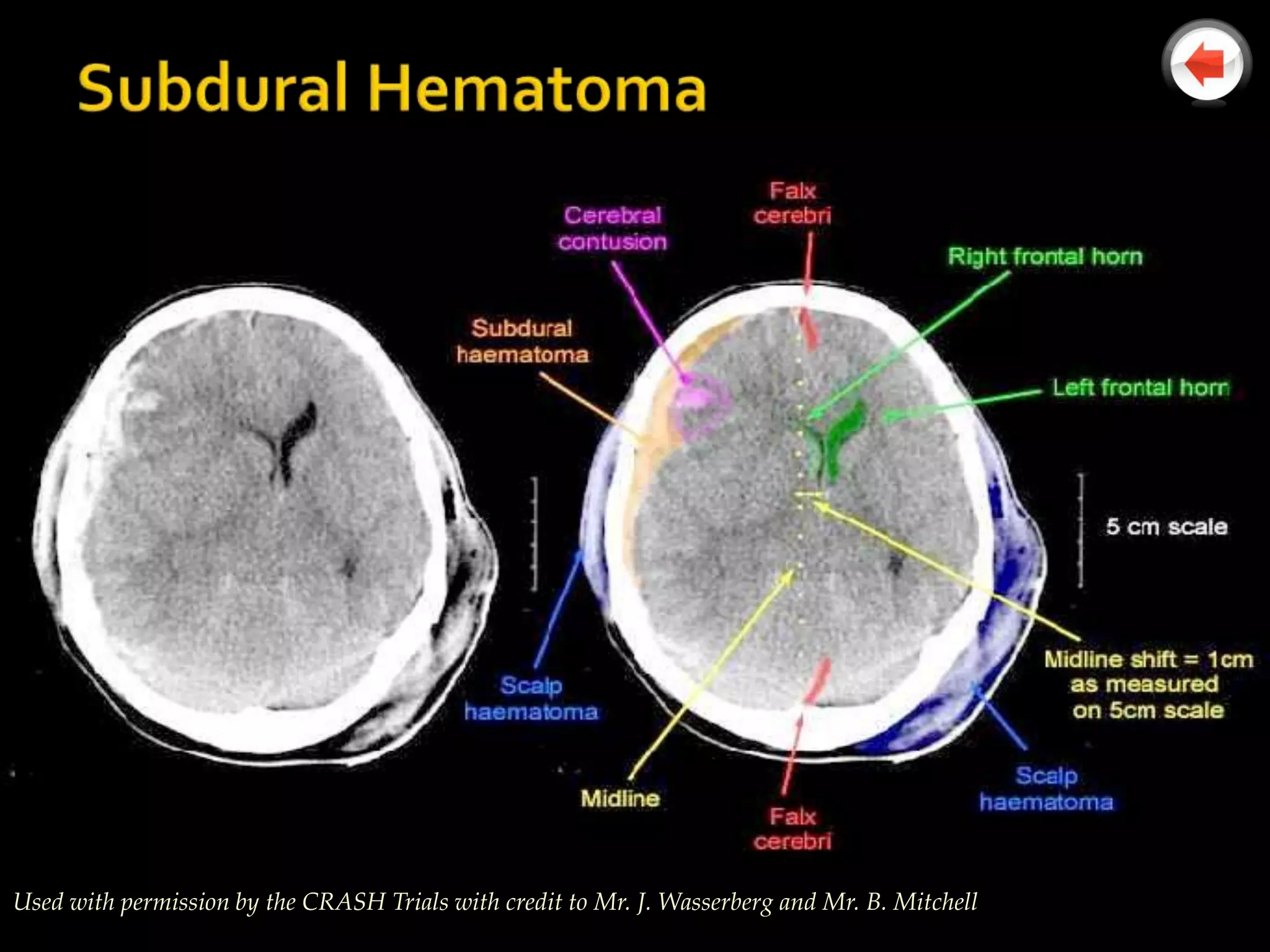 Used with permission by the CRASH Trials with credit to Mr. J. Wasserberg and Mr. B. Mitchell
 