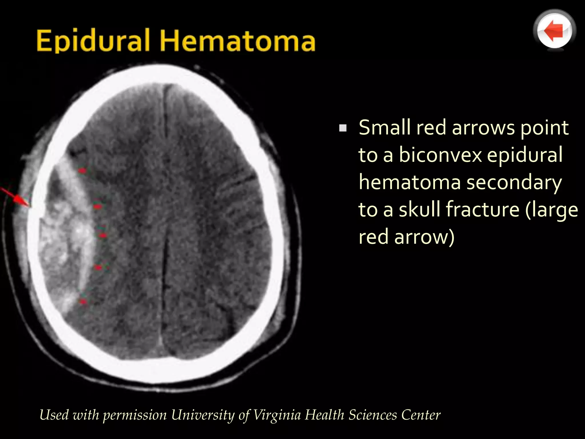    Small red arrows point
                                                     to a biconvex epidural
                                                     hematoma secondary
                                                     to a skull fracture (large
                                                     red arrow)




Used with permission University of Virginia Health Sciences Center
 