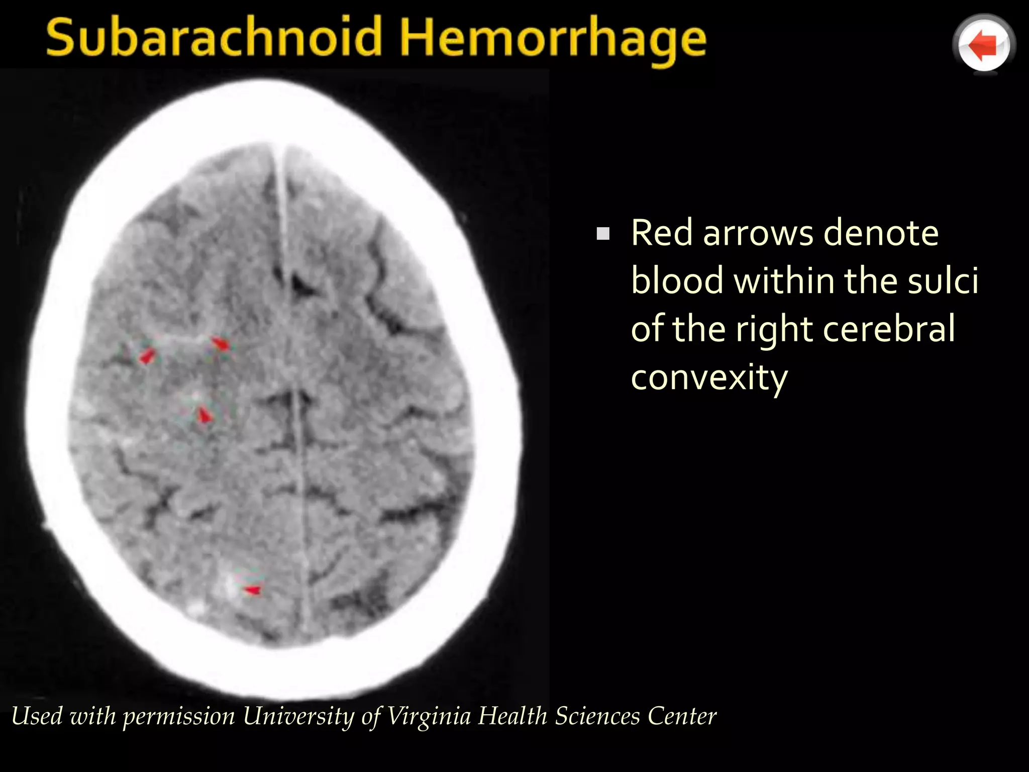    Red arrows denote
                                                          blood within the sulci
                                                          of the right cerebral
                                                          convexity




Used with permission University of Virginia Health Sciences Center
 