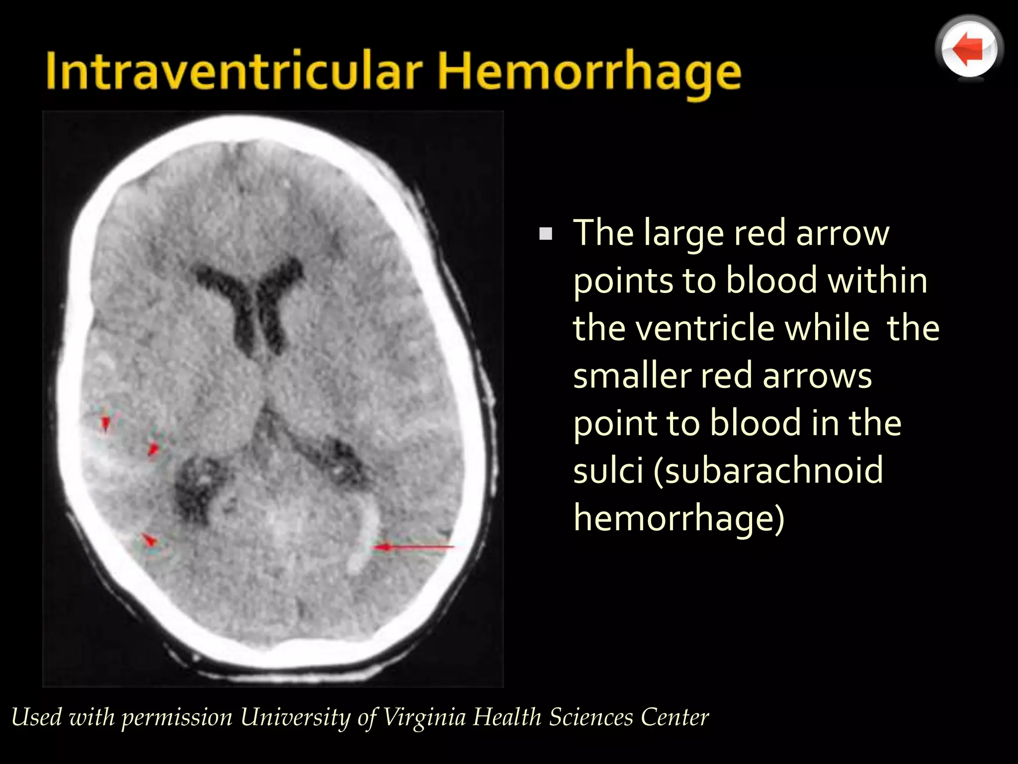   The large red arrow
                                                     points to blood within
                                                     the ventricle while the
                                                     smaller red arrows
                                                     point to blood in the
                                                     sulci (subarachnoid
                                                     hemorrhage)



Used with permission University of Virginia Health Sciences Center
 