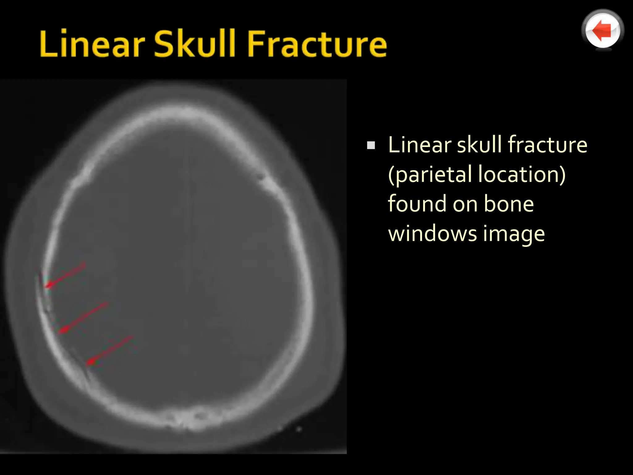    Linear skull fracture
    (parietal location)
    found on bone
    windows image
 