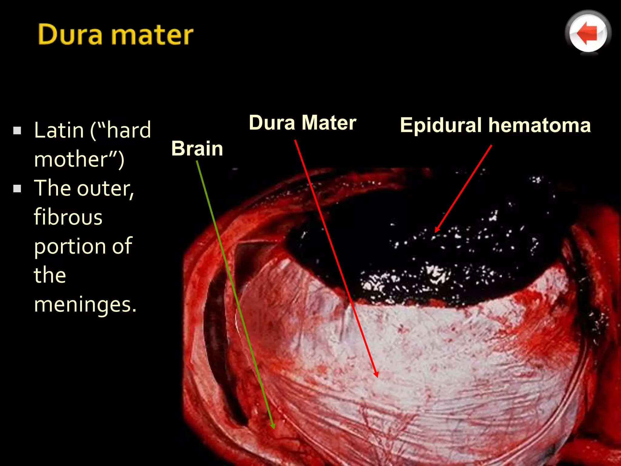  Latin (“hard         Dura Mater   Epidural hematoma
               Brain
  mother”)
 The outer,
  fibrous
  portion of
  the
  meninges.
 