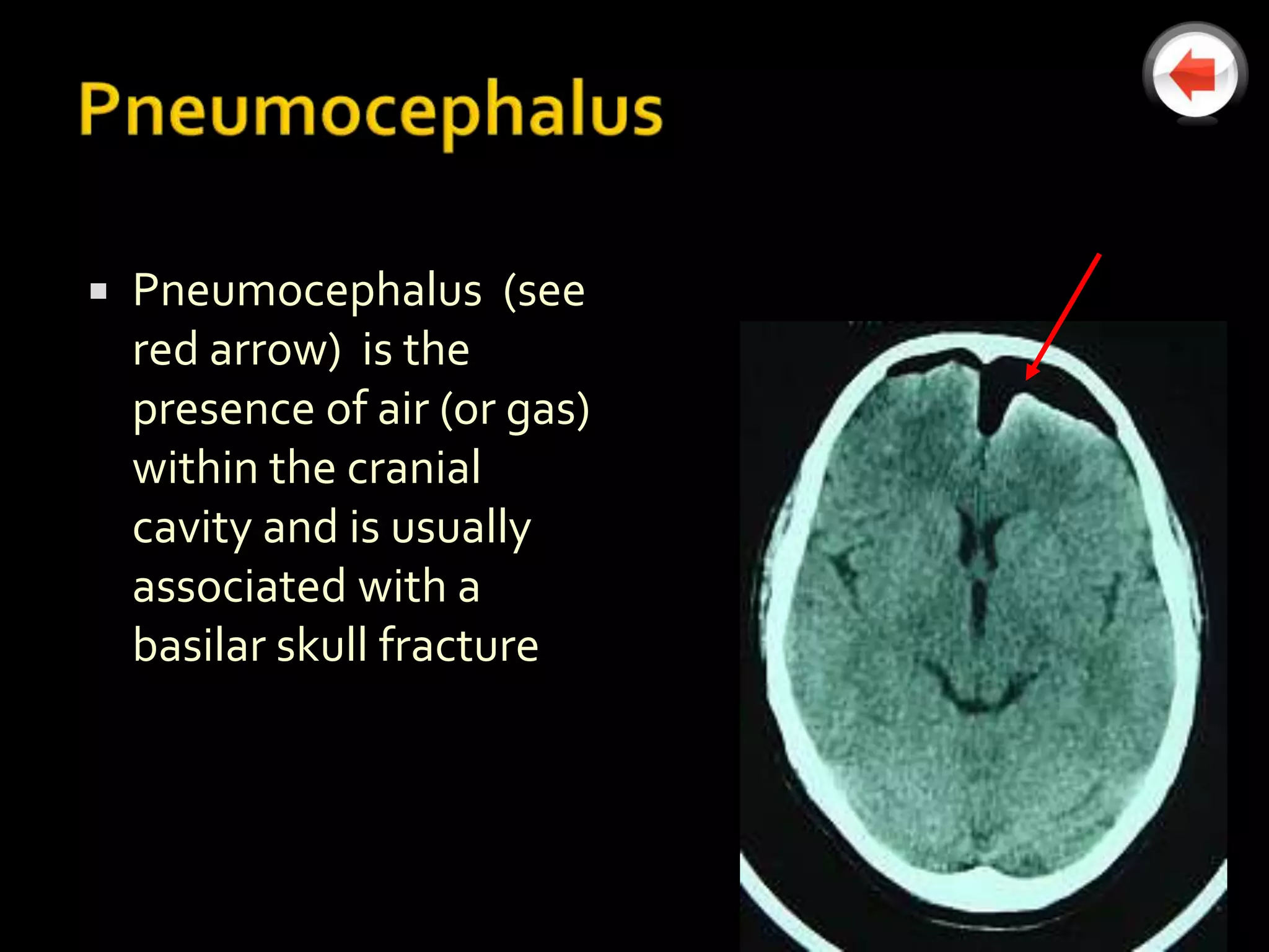    Pneumocephalus (see
    red arrow) is the
    presence of air (or gas)
    within the cranial
    cavity and is usually
    associated with a
    basilar skull fracture
 