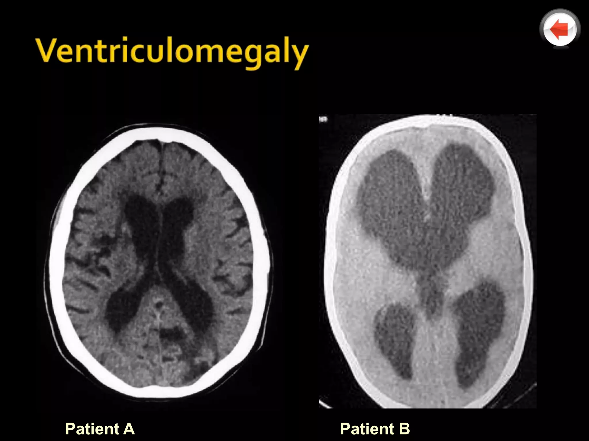 Patient A   Patient B
 