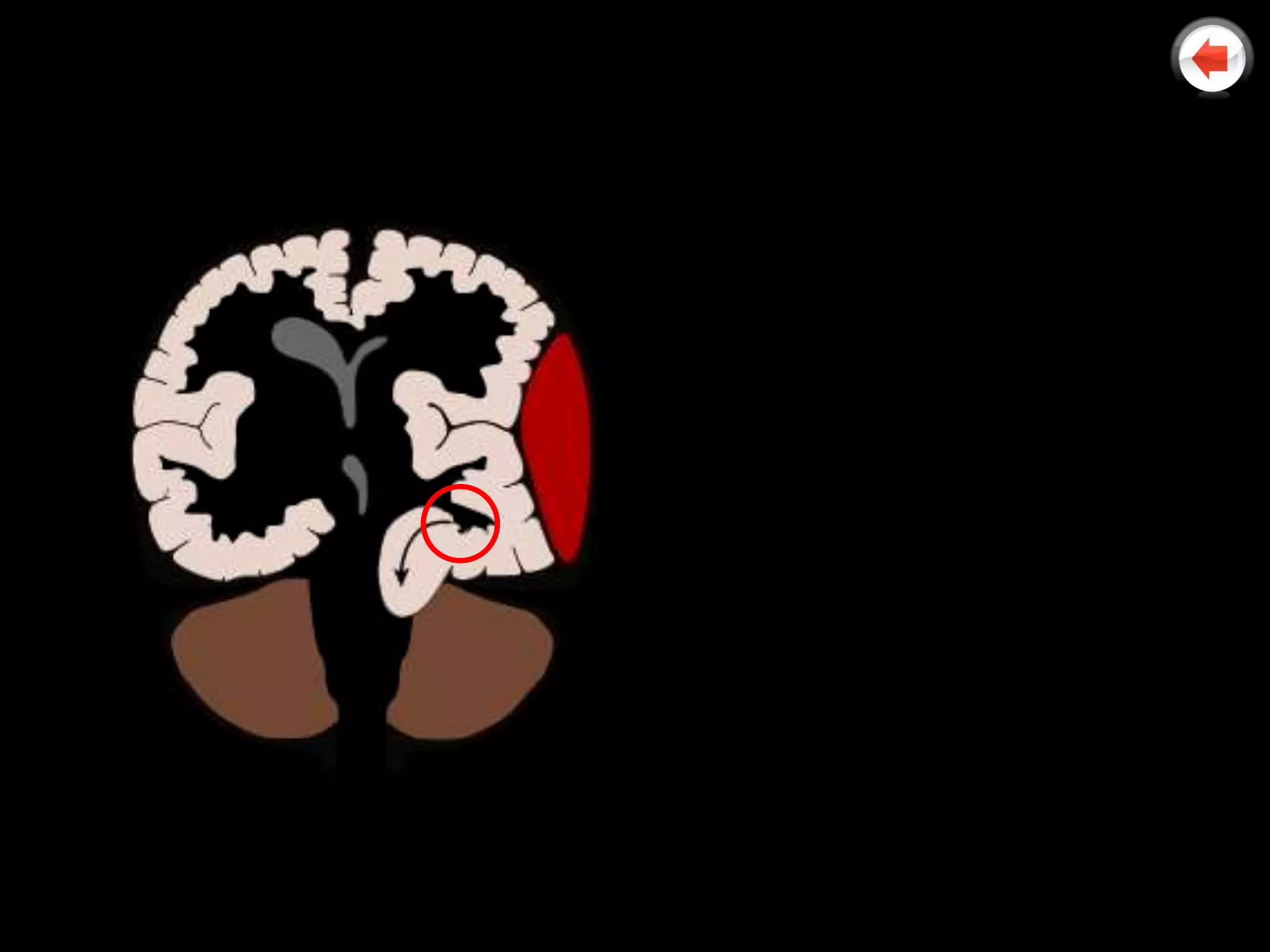 1. The brain squeezes under
   the falx cerebri in
   cingulate herniation
2. The brainstem herniates
   caudally
3. The uncus and the
   hippocampal gyrus
   herniate into the tentorial
   notch
4. The cerebellar tonsils
   herniate through the
   foramen magnum in
   tonsillar herniation
 
