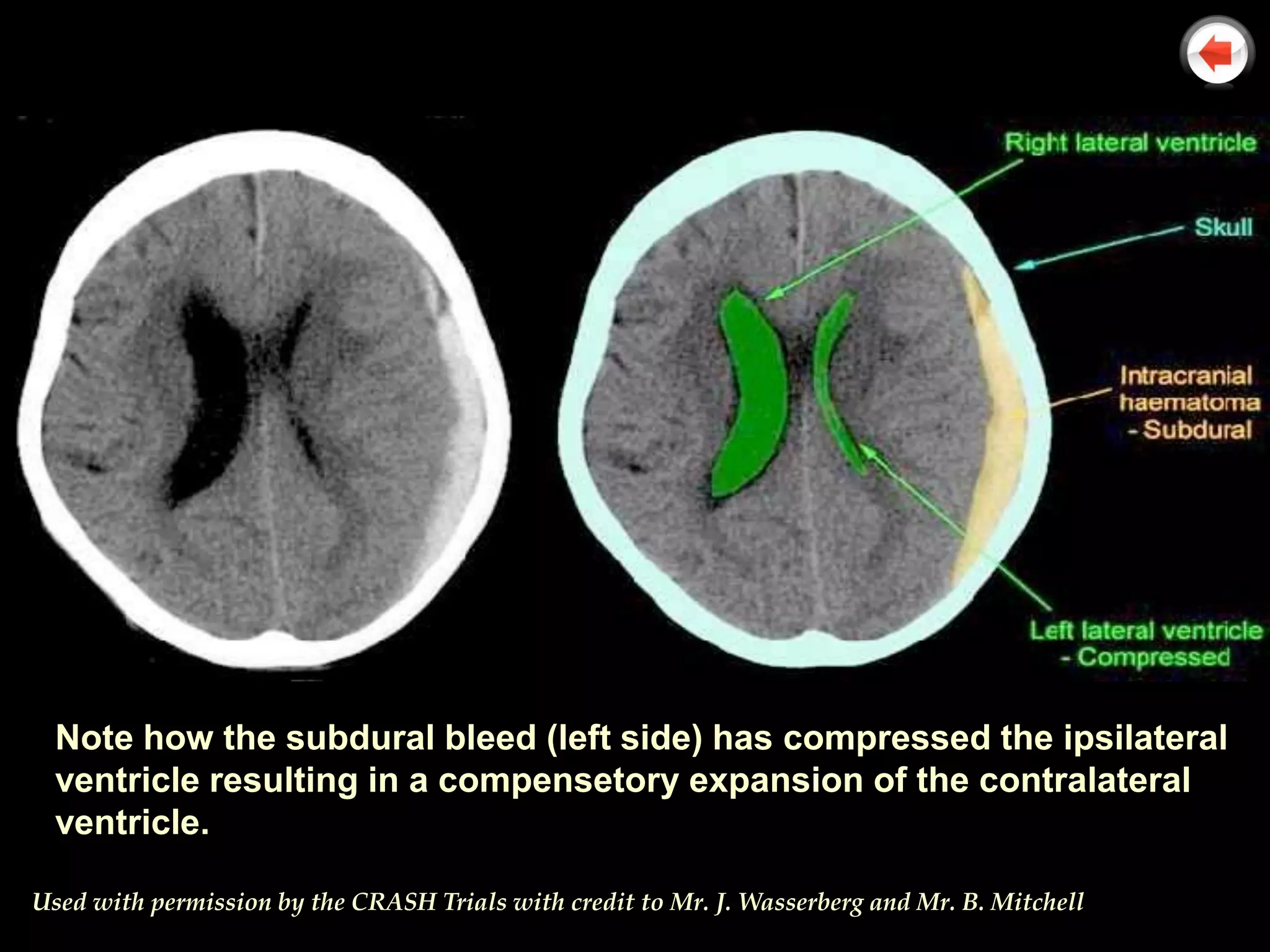 Note how the subdural bleed (left side) has compressed the ipsilateral
  ventricle resulting in a compensetory expansion of the contralateral
  ventricle.

Used with permission by the CRASH Trials with credit to Mr. J. Wasserberg and Mr. B. Mitchell
 