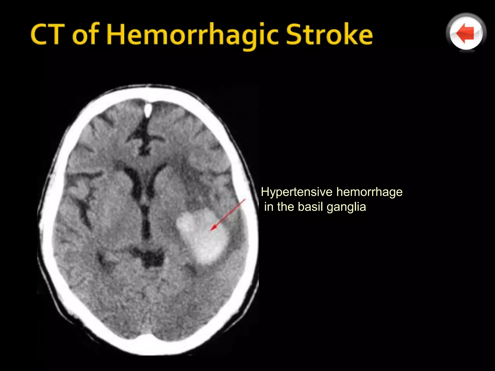 Hypertensive hemorrhage
in the basil ganglia
 