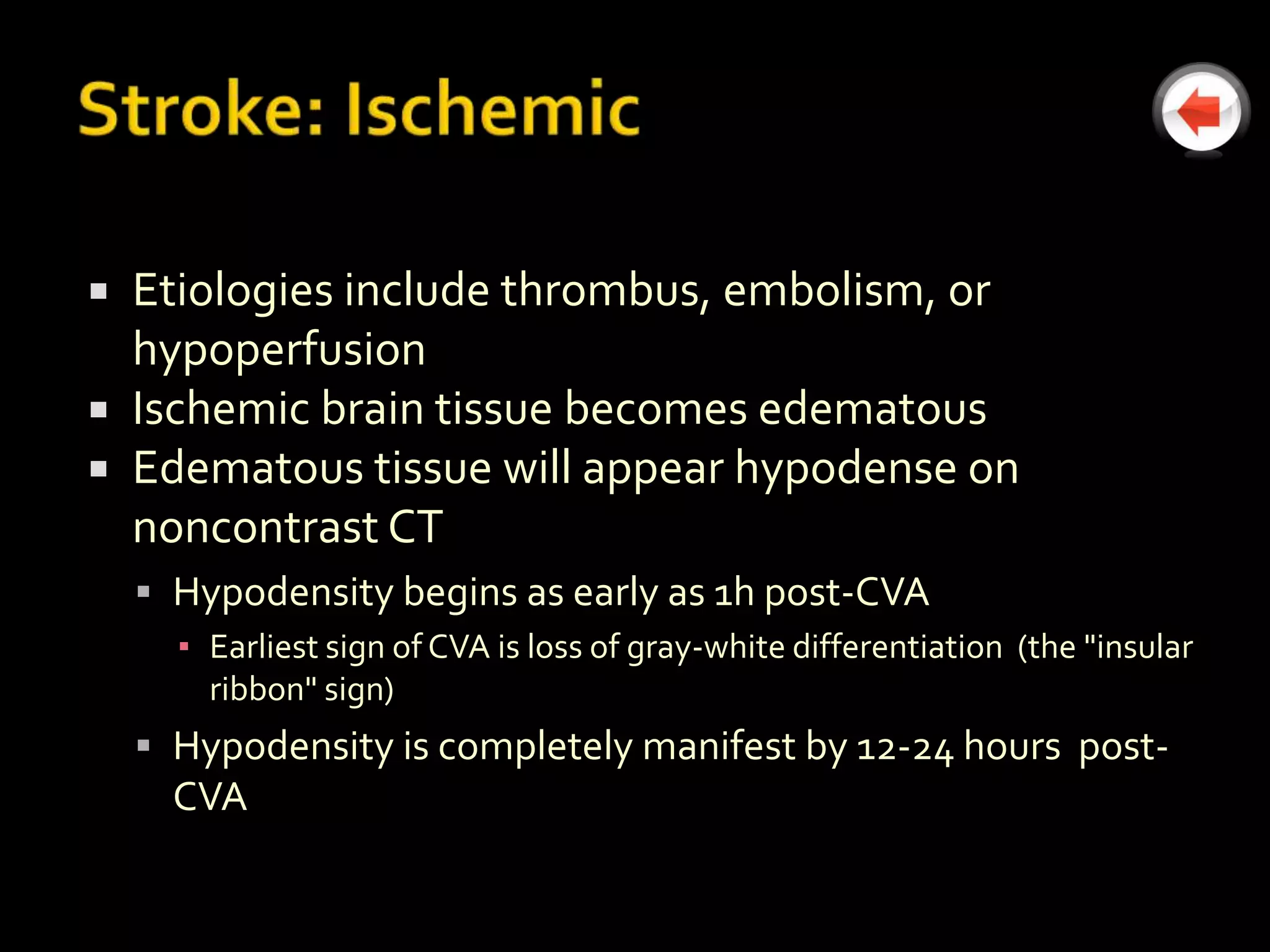  Etiologies include thrombus, embolism, or
  hypoperfusion
 Ischemic brain tissue becomes edematous
 Edematous tissue will appear hypodense on
  noncontrast CT
     Hypodensity begins as early as 1h post-CVA
      ▪ Earliest sign of CVA is loss of gray-white differentiation (the "insular
        ribbon" sign)
     Hypodensity is completely manifest by 12-24 hours post-
      CVA
 