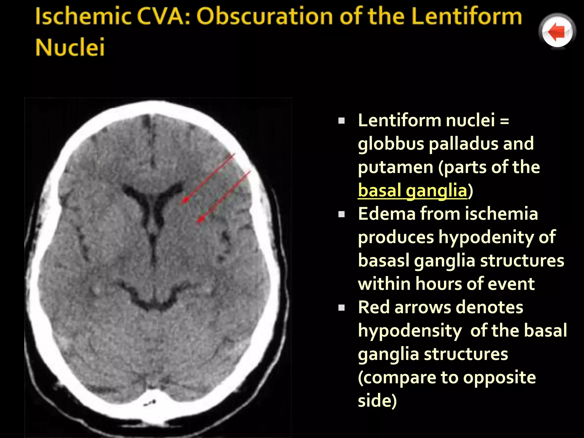    Lentiform nuclei =
    globbus palladus and
    putamen (parts of the
    basal ganglia)
   Edema from ischemia
    produces hypodenity of
    basasl ganglia structures
    within hours of event
   Red arrows denotes
    hypodensity of the basal
    ganglia structures
    (compare to opposite
    side)
 