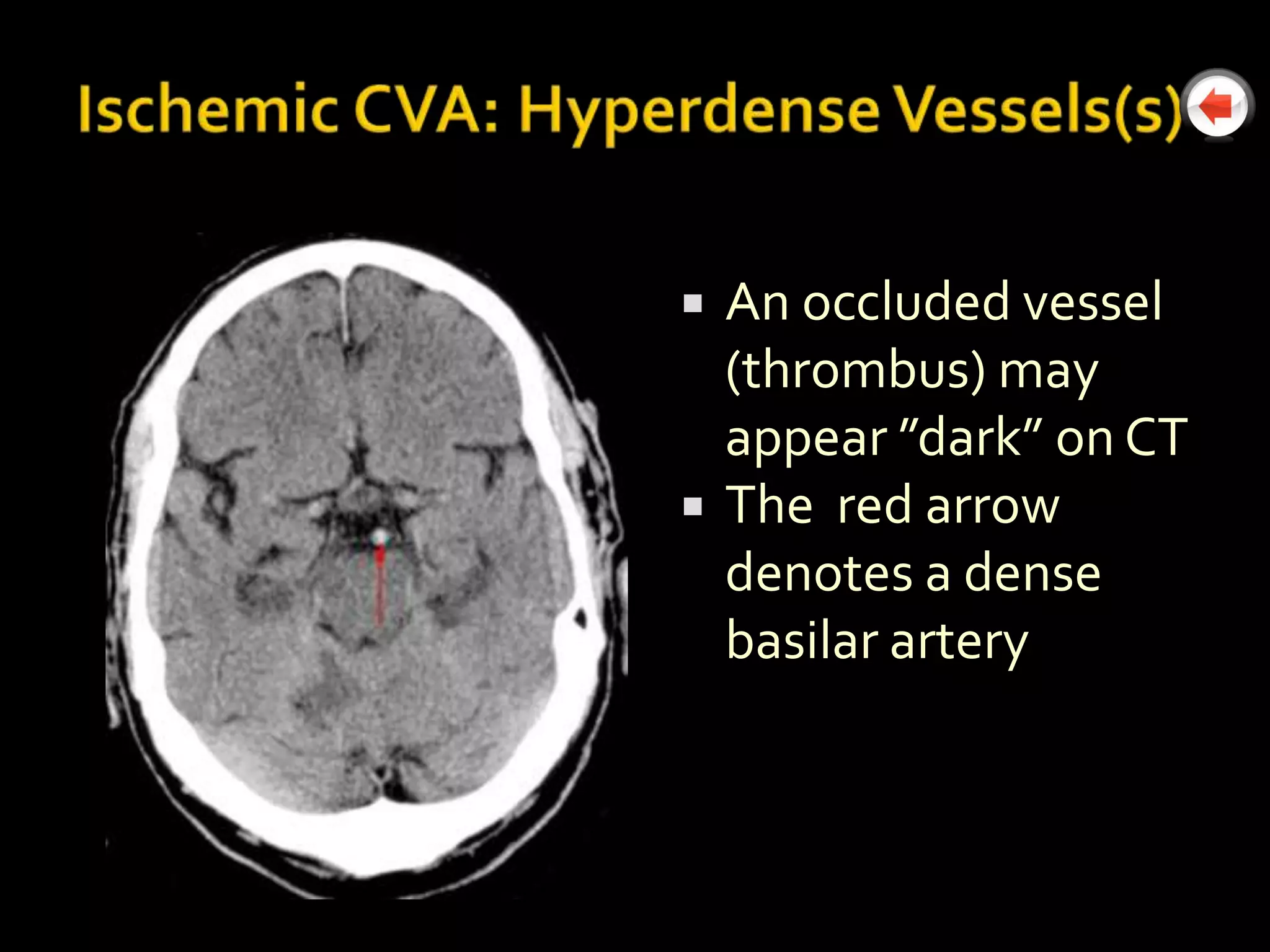    An occluded vessel
    (thrombus) may
    appear ”dark” on CT
   The red arrow
    denotes a dense
    basilar artery
 
