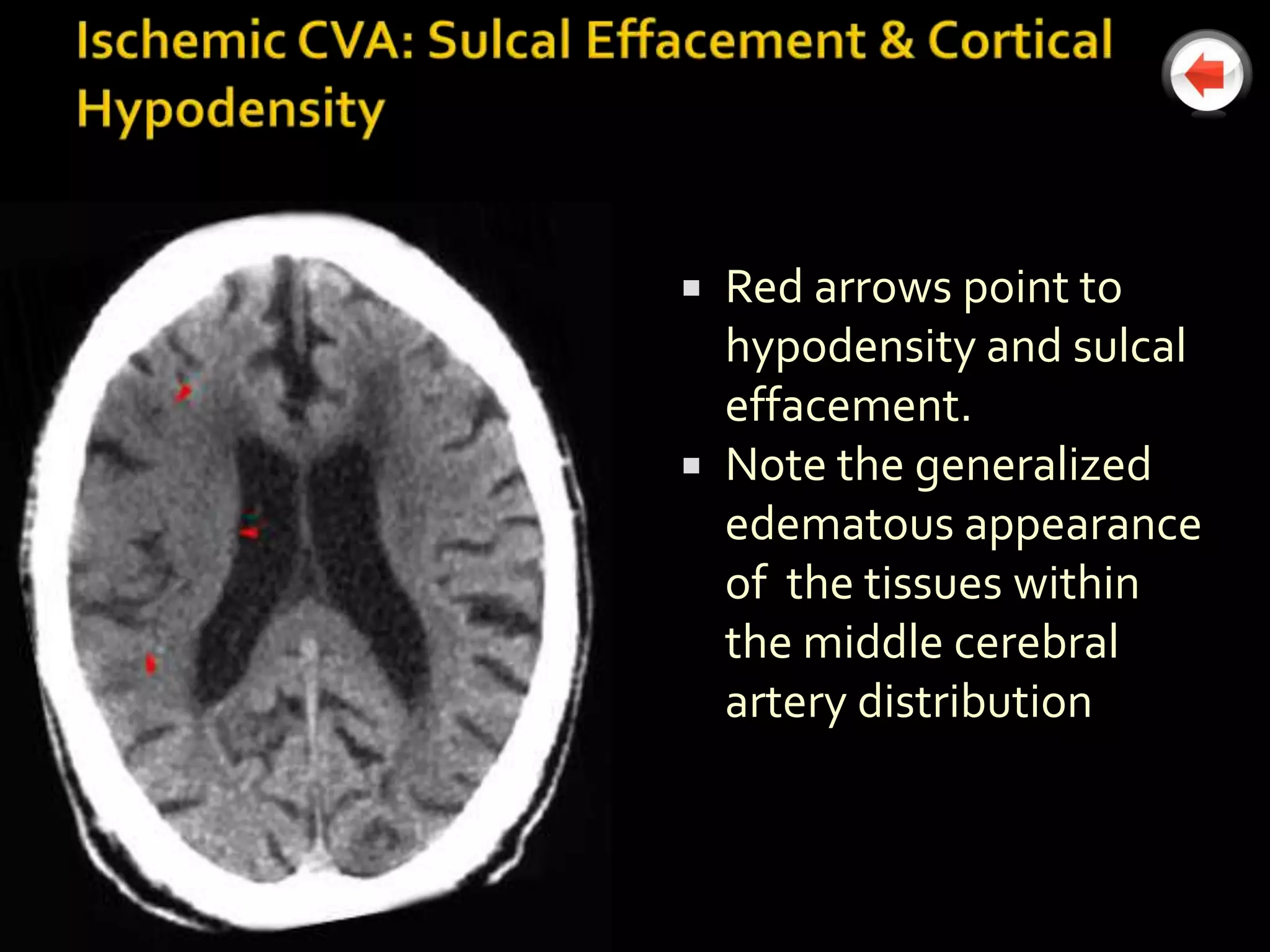  Red arrows point to
  hypodensity and sulcal
  effacement.
 Note the generalized
  edematous appearance
  of the tissues within
  the middle cerebral
  artery distribution
 