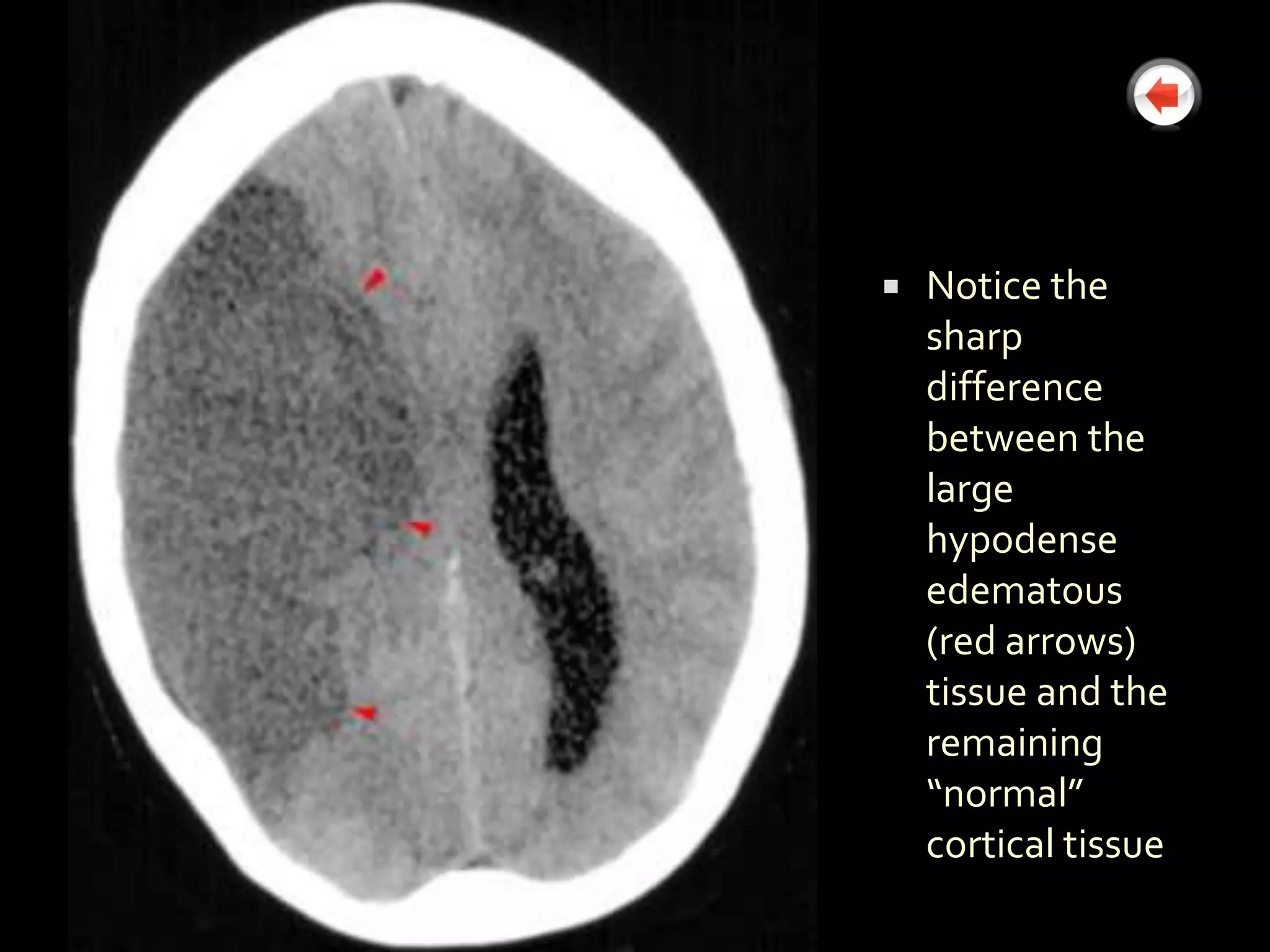    Notice the
    sharp
    difference
    between the
    large
    hypodense
    edematous
    (red arrows)
    tissue and the
    remaining
    “normal”
    cortical tissue
 