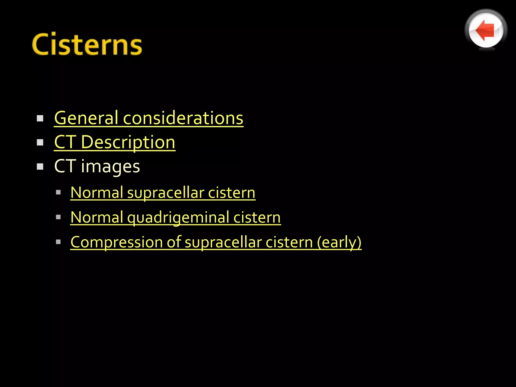    General considerations
   CT Description
   CT images
     Normal supracellar cistern
     Normal quadrigeminal cistern
     Compression of supracellar cistern (early)
 