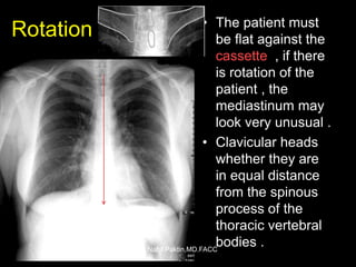 Chest-X ray , How to read a CXR | PPSX
