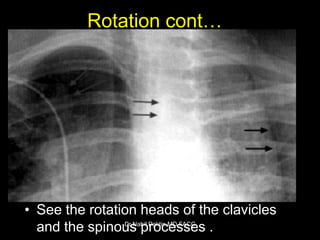 Chest-X ray , How to read a CXR | PPSX