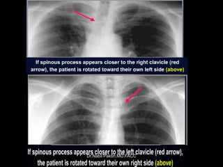 Chest-X ray , How to read a CXR | PPSX