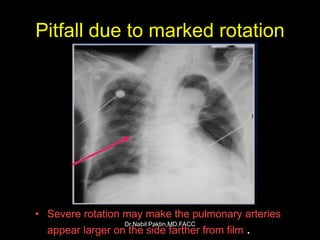 Chest-X ray , How to read a CXR | PPSX