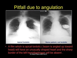 Lindblom Method Chest-X ray , How to read a CXR | PPSX