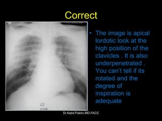 Lindblom Method Chest-X ray , How to read a CXR | PPSX