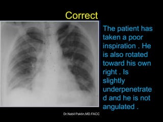 Chest-X ray , How to read a CXR | PPSX