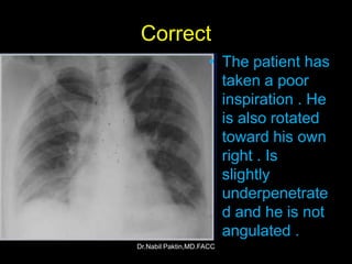 Chest-X ray , How to read a CXR | PPSX