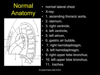 Chest-X ray , How to read a CXR | PPSX
