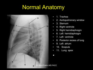 Chest-X ray , How to read a CXR | PPSX