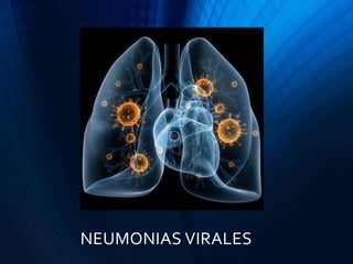NEUMONIAS VIRALES
 
