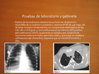 Pruebas de laboratorio y gabinete
• Dentro de los exámenes destaca leucocitosis de 18 900/mm3,
neutrofilia de 10 773/mm3 y proteína C reactiva (PCR) de 146 mg/L, Rx
de tórax muestra condensación con componente atelectásico en los
LM, LID y LII (figura 1), inmunofluorescencia indirecta (IFI) positiva
para adenovirus (ADV), la paciente es aislada y por sospecha de
neumonía mixta se le indica penicilina sódica, que luego se cambia a
ceftriaxona más cloxacilina, esquema que se mantiene durante 7
días.
 