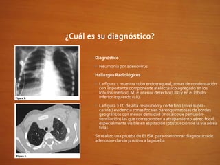 ¿Cuál es su diagnóstico?
Diagnóstico
• Neumonía por adenovirus.
Hallazgos Radiológicos
• La figura 1 muestra tubo endotraqueal, zonas de condensación
con importante componente atelectásico agregado en los
lóbulos medio (LM) e inferior derecho (LID) y en el lóbulo
inferior izquierdo (LII).
• La figura 2TC de alta resolución y corte fino (nivel supra-
carinal) evidencia zonas focales parenquimatosas de bordes
geográficos con menor densidad (mosaico de perfusión-
ventilación) las que corresponden a atrapamiento aéreo focal,
especialmente visible en espiración (obstrucción de la vía aérea
fina).
Se realizo una prueba de ELISA para corroborar diagnostico de
adenosine dando positivo a la prueba
 