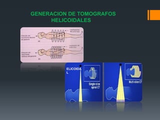 GENERACION DE TOMOGRAFOS
HELICOIDALES
ELICOIDA
L
 