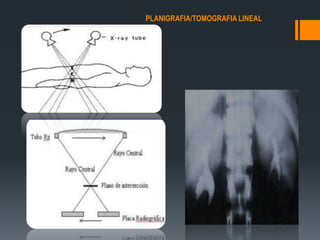 PLANIGRAFIA/TOMOGRAFIA LINEAL
 