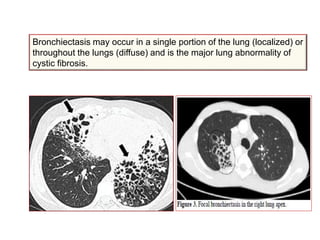 Bronchiectasis may occur in a single portion of the lung (localized) or
throughout the lungs (diffuse) and is the major lung abnormality of
cystic fibrosis.
 