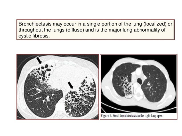 NAC In Respiratory Diseases